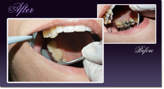 Patient's teeth before and after changing a silver amalgam restoration to a porcelain inlay/onlay restoration