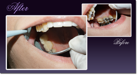 Patient's teeth before and after changing a silver amalgam restoration to a porcelain inlay/onlay restoration