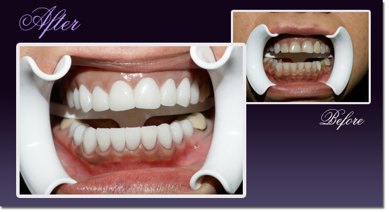 Patient's teeth before and after stained teeth were fitted with white crowns