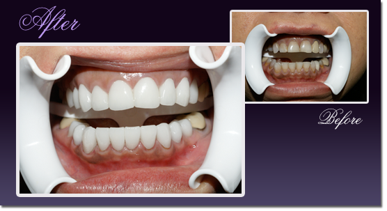 Patient's teeth before and after stained teeth were fitted with white crowns