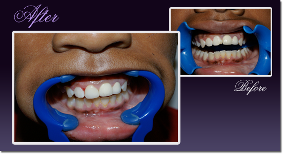 Patient's teeth before and after replacing a broken front teeth with a porcelain veneer restoration