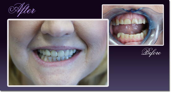 Patient's teeth before and after restoration with Snap-On Smile