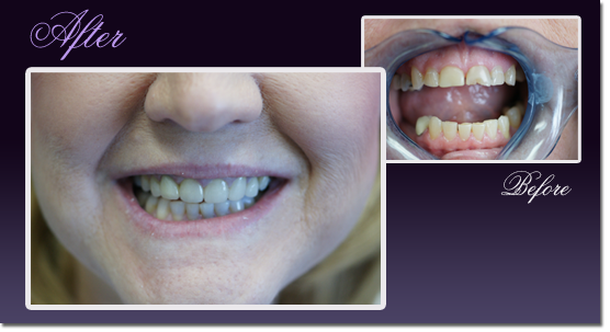 Patient's teeth before and after restoration with Snap-On Smile