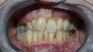 Patient's teeth before Emax porcelain veneers