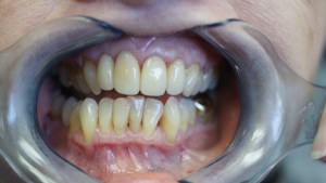 Patient's teeth after Emax porcelain veneers