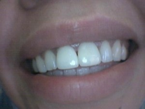 Patient's teeth after Empress porcelain veneers