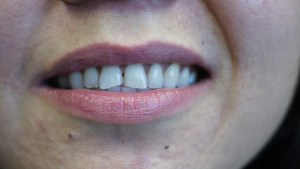 Patient's teeth before Empress porcelain veneers