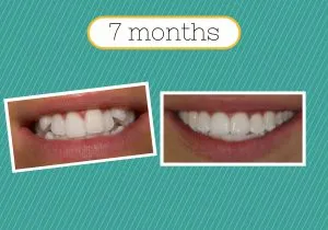 Adult braces by Smilefast 7 months