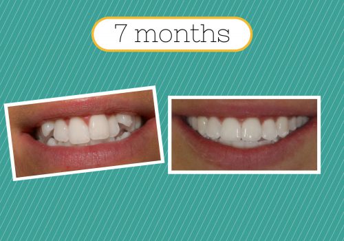 Adult braces by Smilefast 7 months
