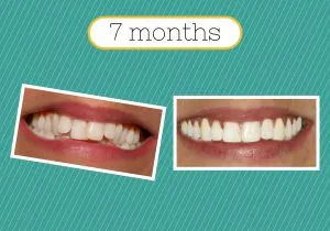 Smilefast adult braces 7 months
