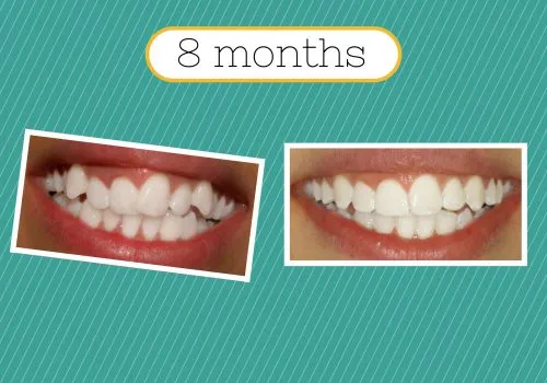 Smilefast adult braces 8 months