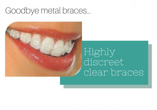 Clear braces by Smilefast